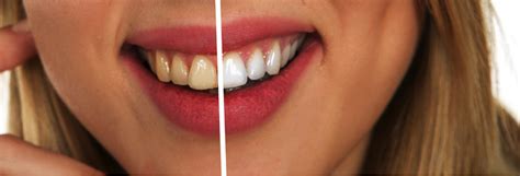 6 Causes Of Stained Teeth You Should Know (And How to Prevent Yellow Teeth)