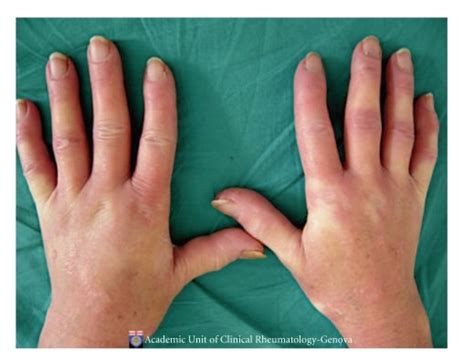 Hands of a patient with early systemic sclerosis suffering from ...