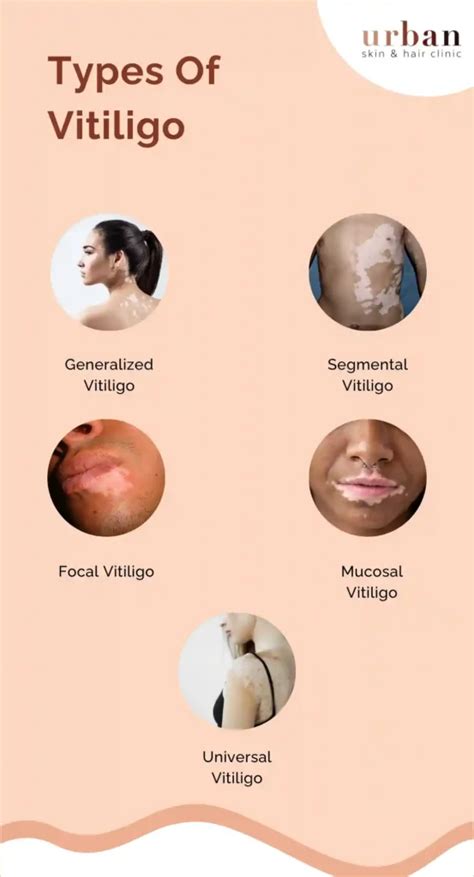 Vitiligo: Causes, Types & Symptoms | Urban Skin & Hair Clinic