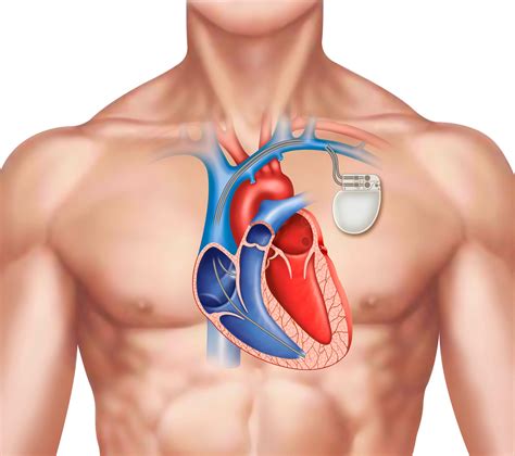 Pacemaker Implantation