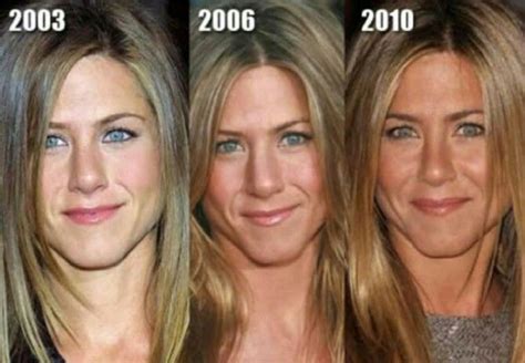 Before and After Plastic Surgery - Jennifer Aniston Nose Fillers, Botox ...