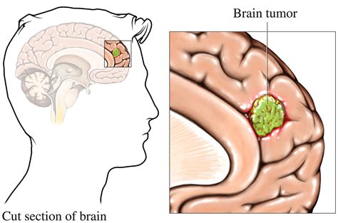 Brain Cancer Causes