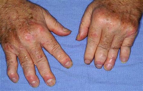 Psoriatic Arthritis - Causes, Symptoms, Diagnosis, Diet & Treatment