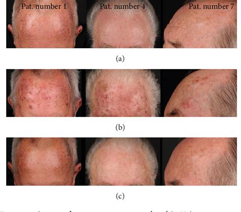 Figure 1 from Visualization and Treatment of Subclinical Actinic ...