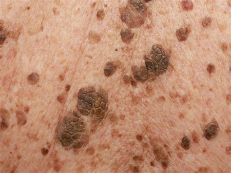 Seborrheic Keratoses Seborrheic Keratosis Symptoms Causes | Images and ...