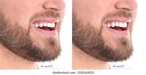 Young Man Before After Gingivoplasty Procedure Stock Photo 2150163523 ...