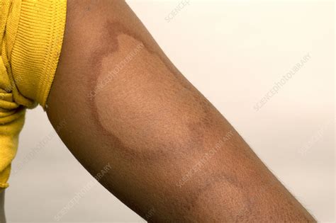 Tuberculoid leprosy - Stock Image - C049/8030 - Science Photo Library