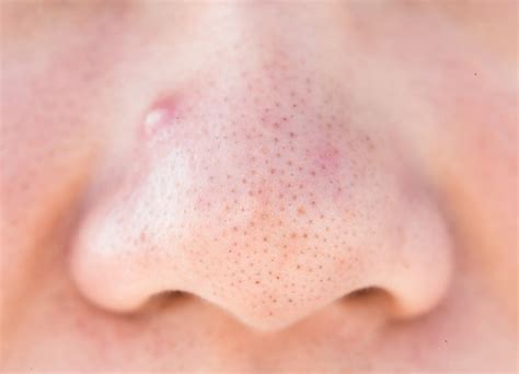 Understanding Blackheads: Causes, Prevention, and Effective Solutions ...