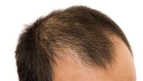 Signs Of Balding