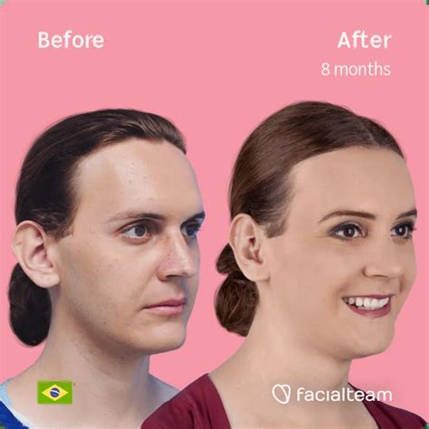 Adam’s Apple Reduction vs. Voice Feminization — Facialteam