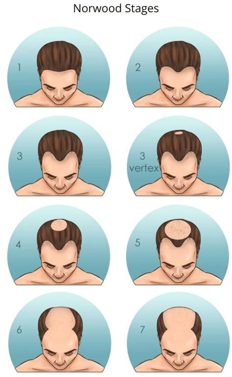 Hair Transplant for Receding Hairline - Heva Clinic