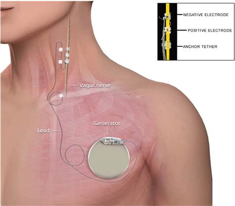 Placement of vagus nerve stimulation device. As illustrated in the ...