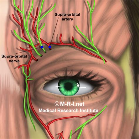 Surpaorbital / Supratrochlear Nerve Blocks Effective in Migraine – A ...