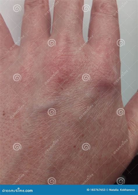 Rash and Hives on the Skin of the Back of the Female Hand, Allergic ...