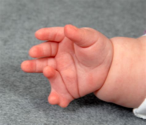 Small finger polydactyly, extra fingers | Congenital Hand and Arm ...