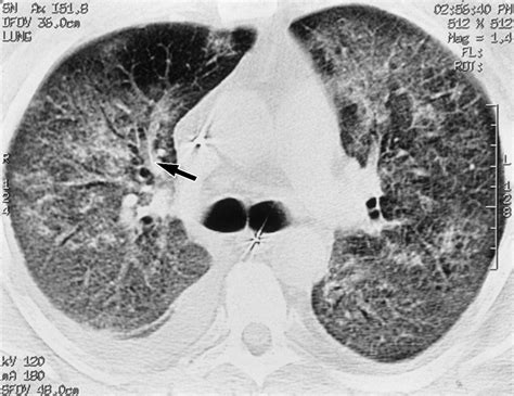 Edema polmonare acuto – Le Malattie dell'Apparato Respiratorio