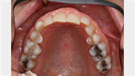 Maxillary First Premolar Extractions for Orthodontics – a Red Flag for ...