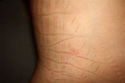 Marks on skin after wearing the cardboard corset.