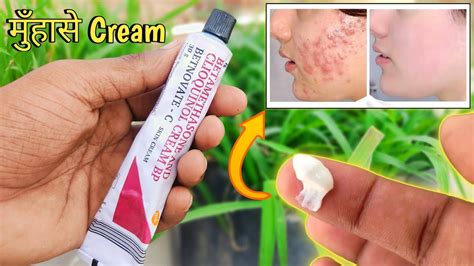 Betnovate - C Skin Cream लगाने का सही तरीका! Acne Removal Skin Cream का ...