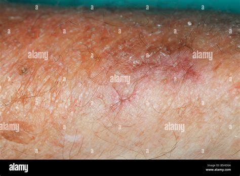 skin thinning or atrophy on an elderly man's arm Stock Photo - Alamy