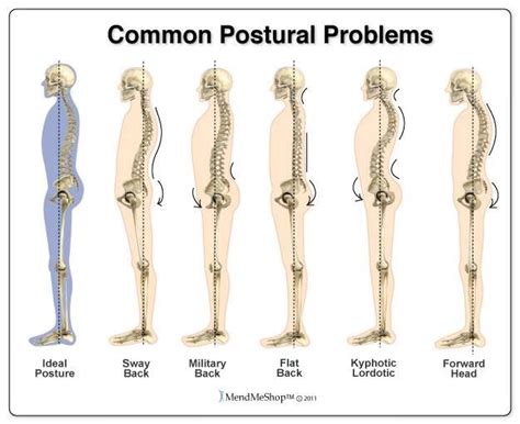 [28+] Lumbar Lordosis Kyphotic Posture