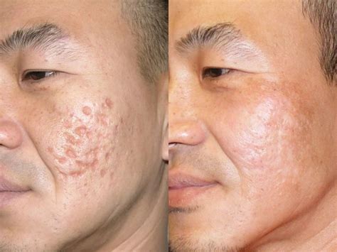 Acne Scars Boulder CO, Ideal Dermatology / Skin. PC