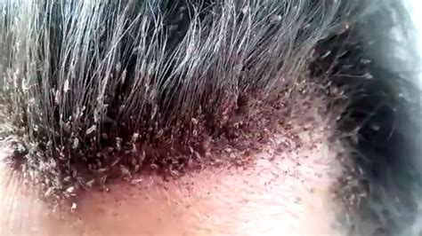 This video of a man's disgusting head lice infestation will make your ...