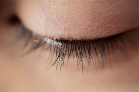 Eyelash Mites: Signs, Causes, and Treatments | MyVision.org