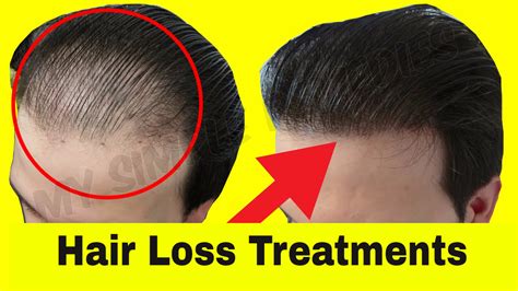 Top 5 Natural Hair Loss Treatment for Men – My Simple Remedies