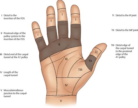 Zones of Flexor Tendon Injuries | Plastic Surgery Key