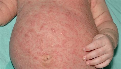 Scabies – symptoms, treatment, causes and photos. What does scabies ...