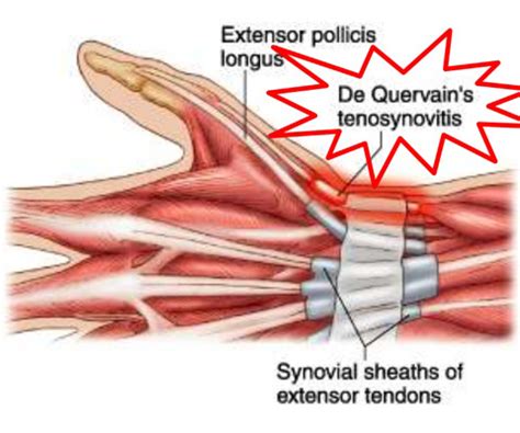 Dequervain’s Tenosynovitis – South Florida Hand Surgery