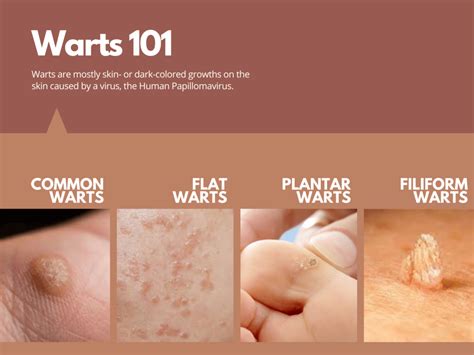 Wart Removal Cpt Code 2024 - Tarah Francene