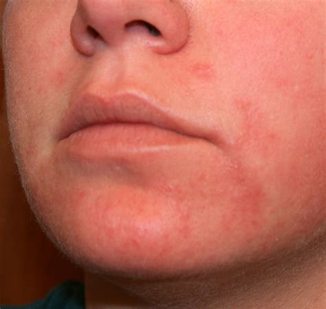 How To Treat An Itchy Face Rash at Norbert Ostrander blog