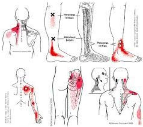 Pin on Psoas Trigger points