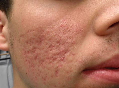 ACD A-Z of Skin - Acne Scars (Acne Scarring)