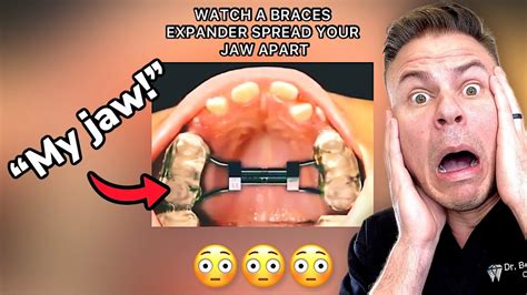 This Braces Expander Will Change Your Jaw AND Face - YouTube