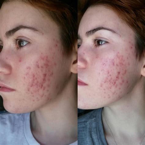 [B&A] Scar Progression 3/10 vs. 3/14. Vitamin C and Rosehip Oil, y'all ...