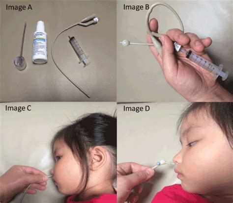 foreign body IN THE NOSE ,treatment