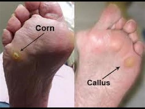 How To Remove Corns/Calluses Using Corn Caps - PROOF - YouTube