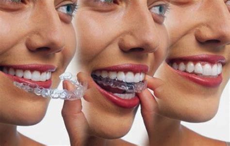 Average Cost Of Invisalign | Forest Hill Village Orthodontics