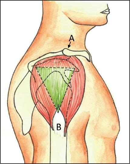 How To Do A Deltoid Injection For TRT - Full Guide + Demo - The TRT Hub