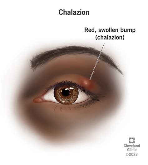 Chalazion: Symptoms, Causes, Prevention & Treatments