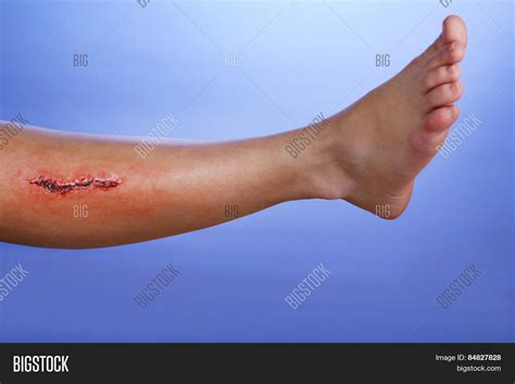 Injured Leg Blood On Image & Photo (Free Trial) | Bigstock