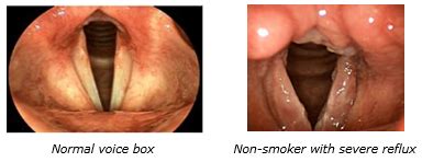 Silent Reflux – The Royal Victorian Eye and Ear Hospital