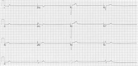 Ventricular Escape Rhythm • LITFL • ECG Library Diagnosis