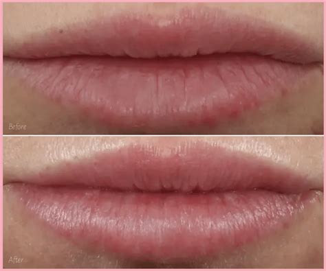 Lip Filler Before And After Pics Thin Lips | Lipstutorial.org