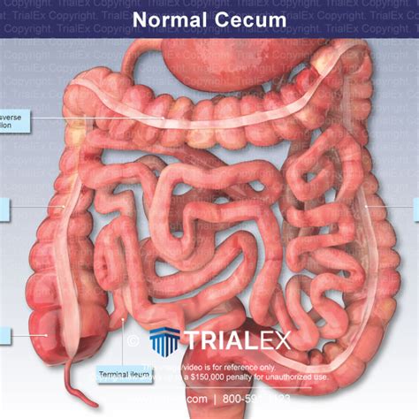 Normal Cecum - TrialQuest Inc.