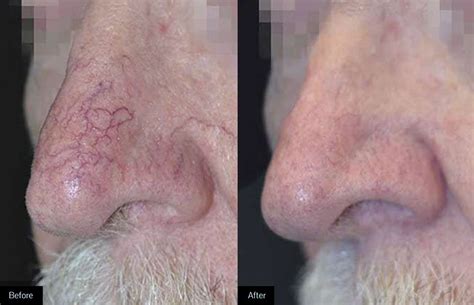 Broken Blood Vessel Treatment — Ingleton Dermatology P.C.