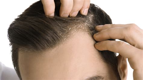 Is Dandruff a Cause of Hair Loss? | Svenson